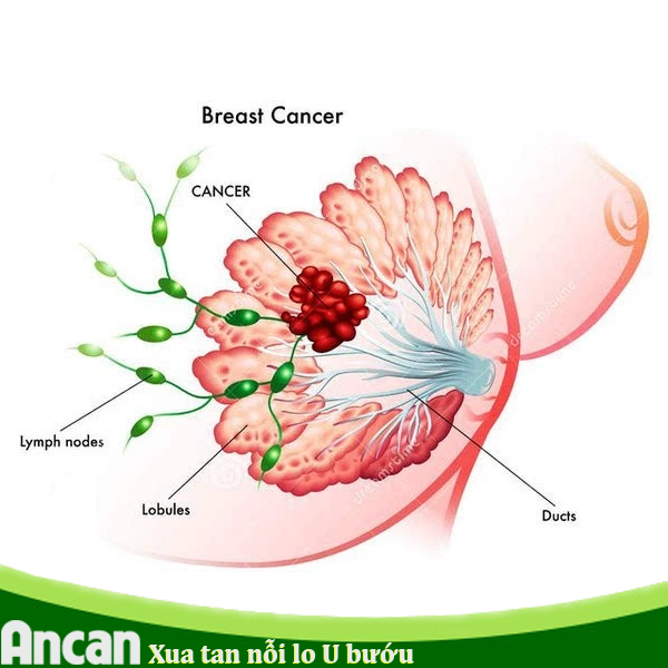 ung thư vú 