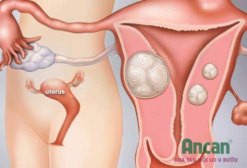 Bị u nang buồng trứng thì phải làm sao?
