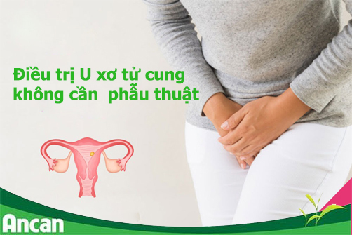 U xơ tử cung: Nguyên nhân, triệu chứng & cách điều trị