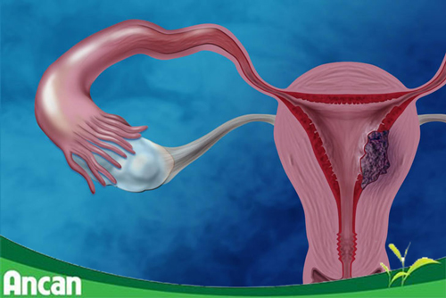 Nguyên nhân gây u xơ tử cung và cách điều trị hiệu quả