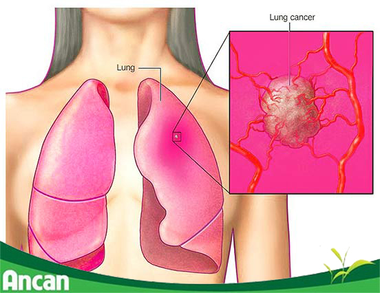 Chữa ung thư phổi giai đoạn cuối như thế nào?