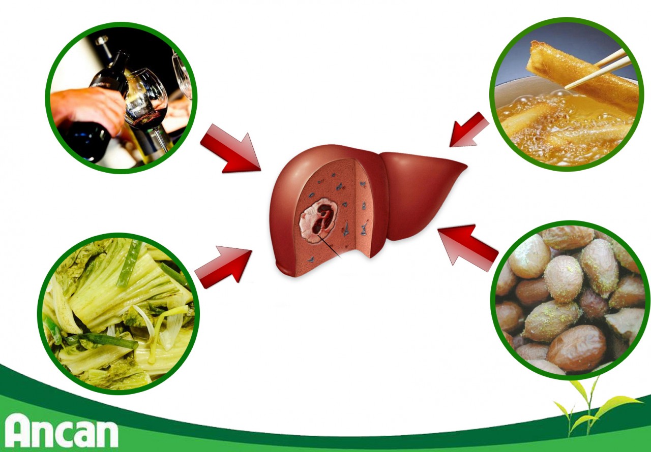 Mắc ung thư gan nếu thường xuyên ăn 4 thực phẩm sau 1