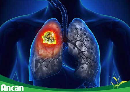 Tại sao ung thư phổi lại nguy hiểm nhất trong các loại ung thư 1
