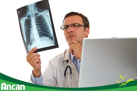 Tại sao ung thư phổi lại nguy hiểm nhất trong các loại ung thư? 2