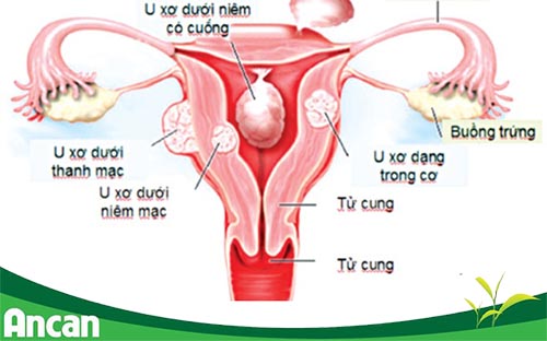 U xơ tử cung biến chứng gây tử vong ở phụ nữ 2
