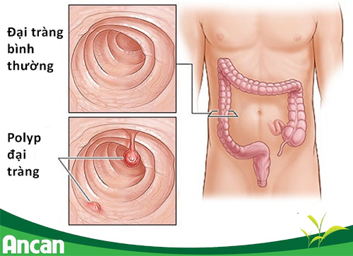 Những điều cần biết về bệnh polyp đại tràng 1
