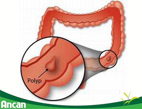 Biểu hiện và nguyên nhân bệnh polyp hậu môn 1