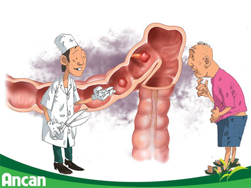 Biểu hiện và nguyên nhân bệnh polyp hậu môn 2