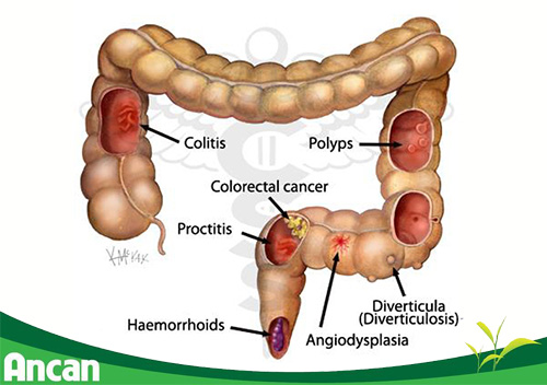 Nguyên nhân và các phương pháp chẩn đoán polyp 1