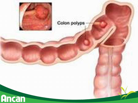 Phân loại và các phương pháp điều trị polyp 1