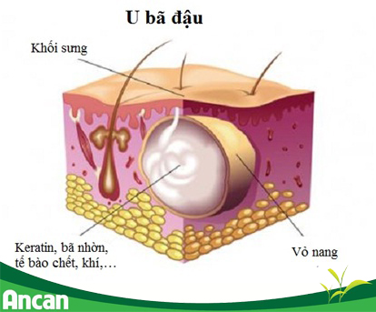 u-ba-dau-la-gi-nguyen-nhan-gay-u-ba-dau-1