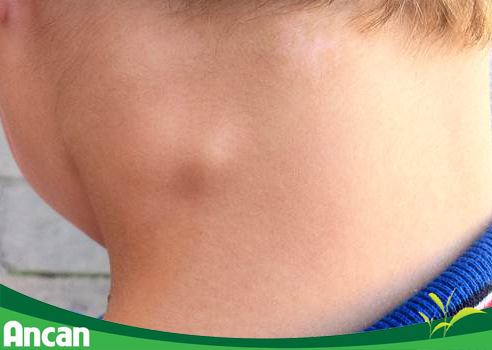  Hạch ở cổ sau gáy là lành tính hay ác tính? 2