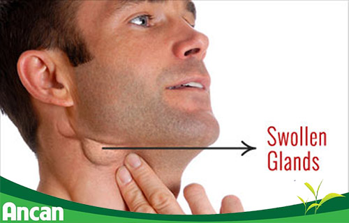 Hạch to liệu có phải ung thư hạch không? 2