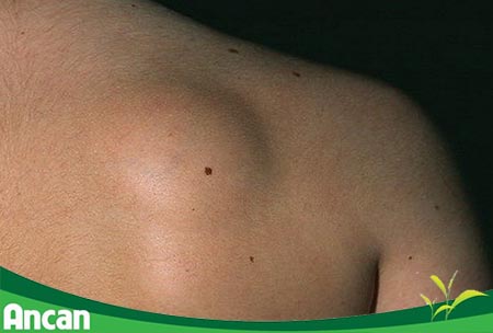 Những điều cần biết về u mỡ 1