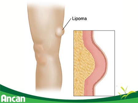 Những điều cần biết về u mỡ 3