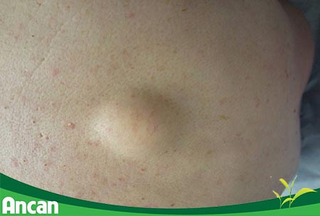 Những điều cần biết về u mỡ 2