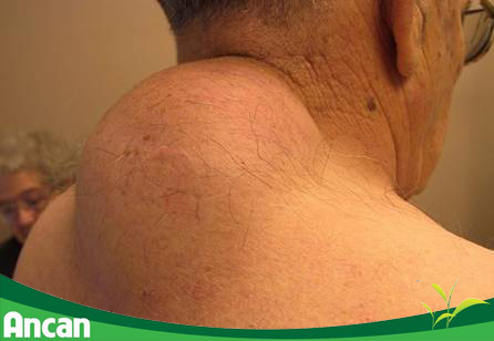 Phân loại u mỡ và cách điều trị u mỡ 1