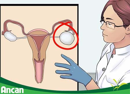 Bệnh u nang buồng trứng trái có nguy hiểm không 1
