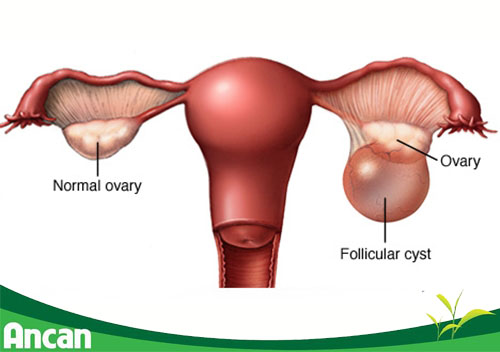 dau-hieu-nhan-biet-u-nang-buong-trung-1