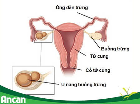 kien-thuc-chung-ve-benh-u-nang-buong-trung-1