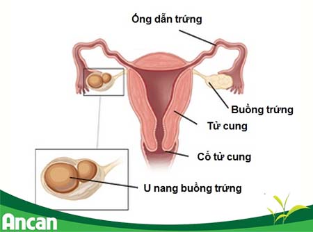 U nang buồng trứng là gì? 1