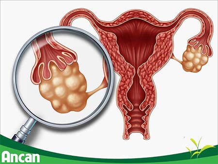 cách điều trị u nang buồng trứng phải 1
