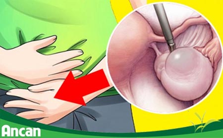 cách điều trị u nang buồng trứng phải 3