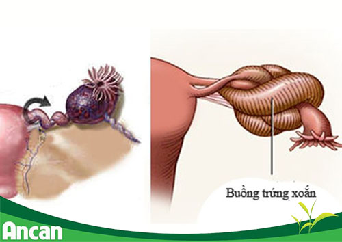 U nang buồng trứng phát triển qua những giai đoạn nào? 2