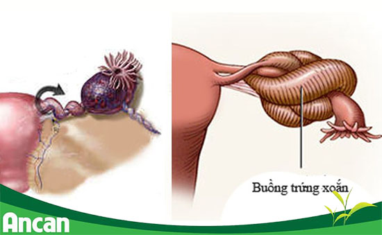 U nang buồng trứng xoắn 1