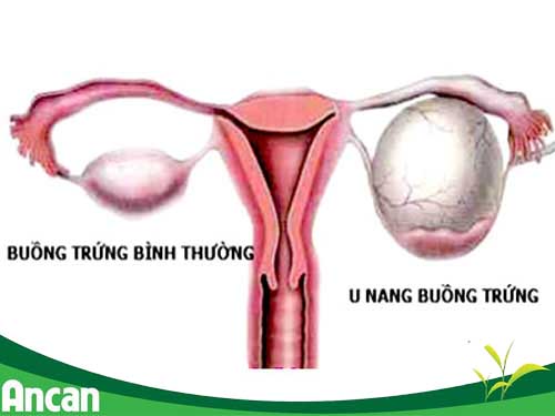 U nang buồng trứng