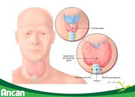 Bệnh basedwo có nguy hiểm không