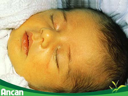 Bệnh suy giáp ở trẻ sơ sinh