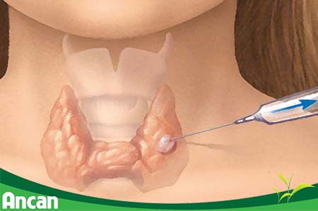 nhân tuyến giáp có nguy hiểm không 3