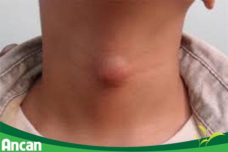 Bướu tuyến giáp