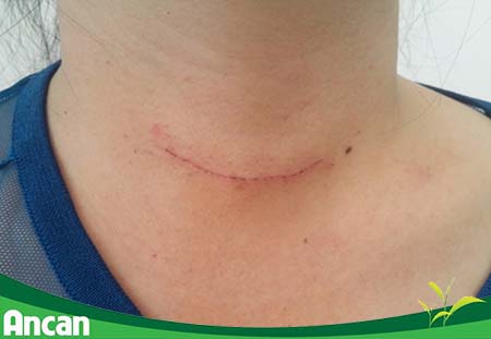 Có nên mổ u tuyến giáp không 2