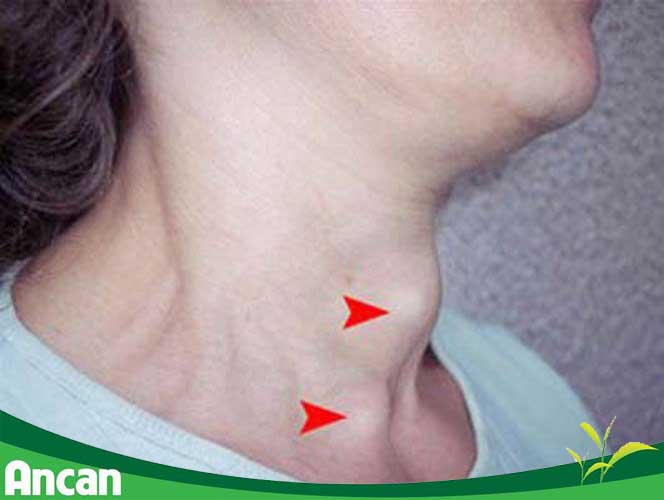 Dấu hiệu bệnh k giáp dạng nhú