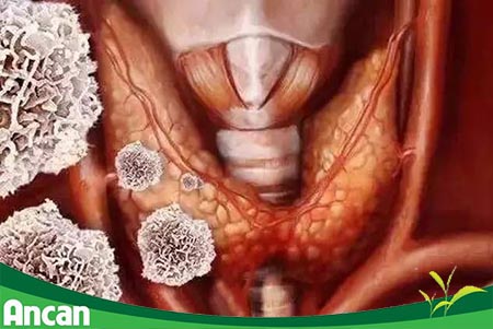 Nguyên nhân gây u tuyến giáp 3