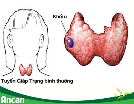 Nguyên nhân và triệu chứng nhân tuyến giáp 1
