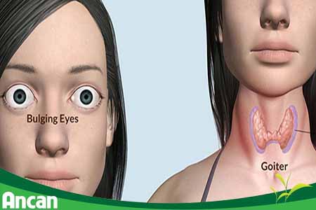 triệu chứng bệnh basedow