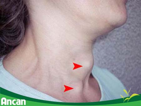 Triệu chứng bệnh bướu tuyến giáp