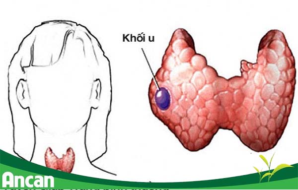 U bướu tuyến giáp ảnh hưởng thế nào đến sức khỏe sinh sản của phụ nữ ?