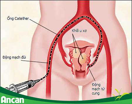 3 điều cần lưu ý đối với bệnh nhân u xơ tử cung 4