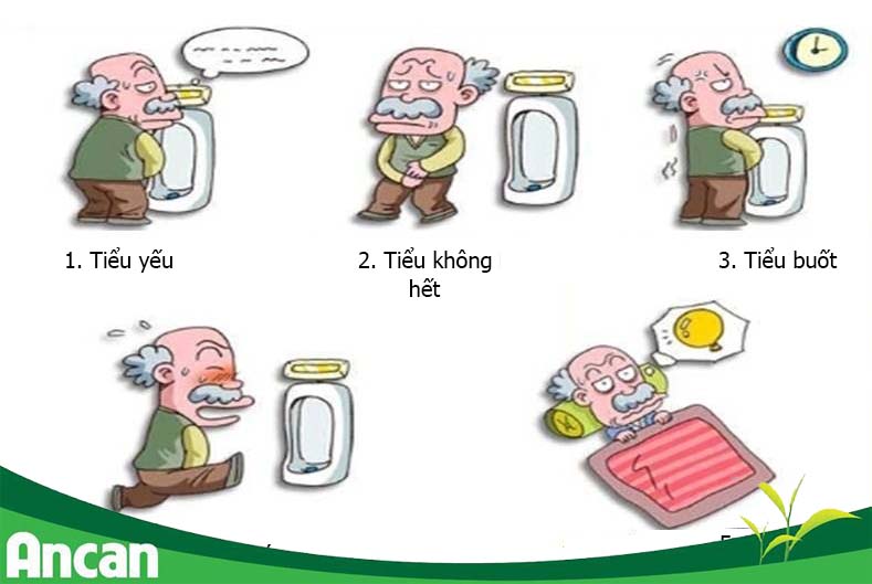 U xơ tiền liệt tuyến - kẻ thù số 1 của nam giới3