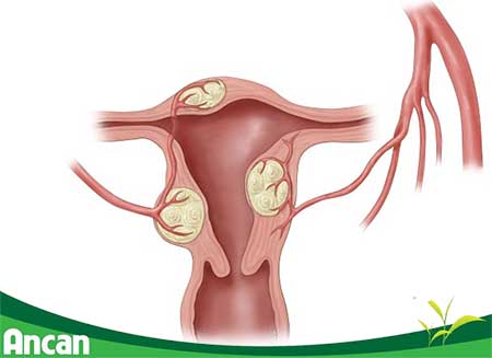 Bệnh u xơ tử cung có nguy hiểm không 1