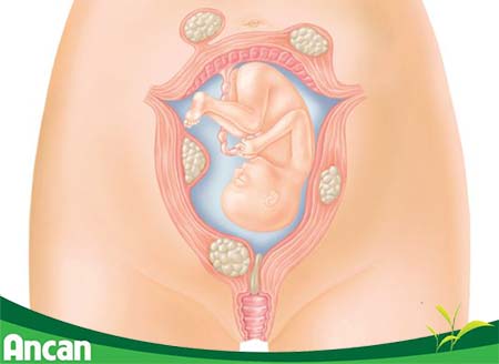 Bệnh u xơ tử cung có nguy hiểm không 3