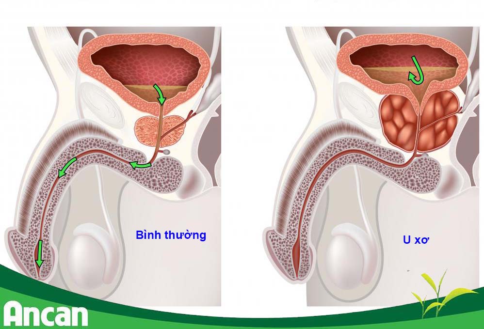 u xơ tiền liệt tuyến - kẻ thù số 1 của nam giới 1