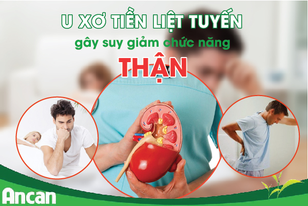 U xơ tiền liệt tuyến có nguy hiểm không ?3