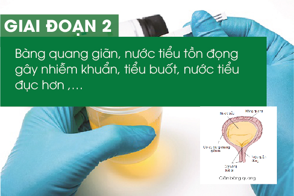 Các giai đoạn phát triển của bệnh u xơ tiền liệt tuyến2