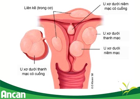 U xơ tử cung là gì 1