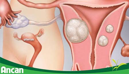 U xơ tử cung là gì 3
